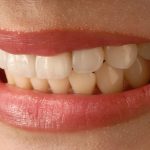 Zobna prevleka kot fiksni protetični nadomestek