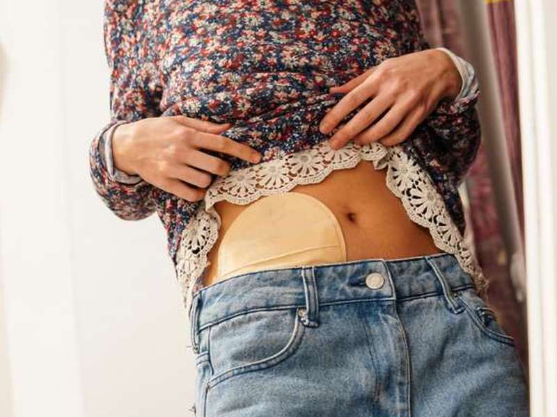 Življenje z ileostomo